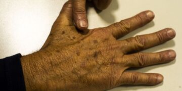 Sociedade médica lança campanha sobre prevenção do câncer de pele