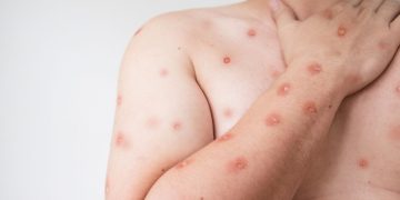 Mpox: diretor do Ministério da Saúde tira dúvidas sobre sintomas, transmissão e cuidados para evitar a doença Mpox: diretor do Ministério da Saúde tira dúvidas sobre sintomas, transmissão e cuidados para evitar a doença