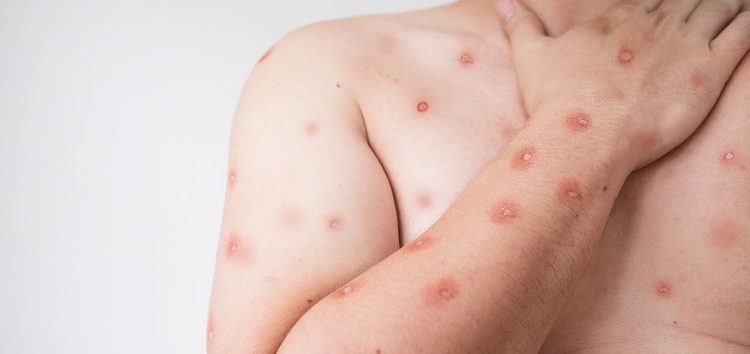 Mpox: diretor do Ministério da Saúde tira dúvidas sobre sintomas, transmissão e cuidados para evitar a doença Mpox: diretor do Ministério da Saúde tira dúvidas sobre sintomas, transmissão e cuidados para evitar a doença