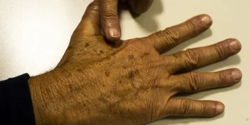 Câncer de pele: com a chegada do verão, prevenção é fundamental para evitar a doença Câncer de pele: com a chegada do verão, prevenção é fundamental para evitar a doença