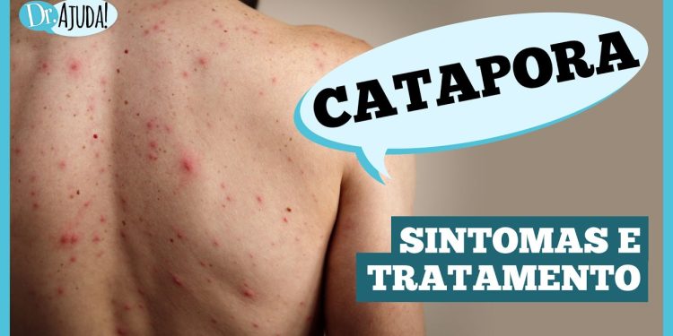 Catapora: sintomas, complicações e prevenção