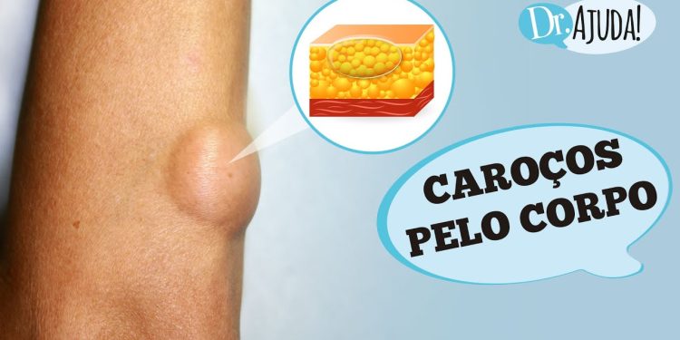 Caroços pelo corpo e lipoma: O que são? O que reparar?