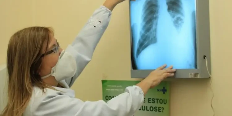 Ministério da Saúde repassa R$ 100 milhões para combate à tuberculose em 913 municípios Ministério da Saúde repassa R$ 100 milhões para combate à tuberculose em 913 municípios
