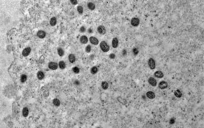 Mpox: São Paulo confirma segundo caso da doença pela nova cepa clado Ib Mpox: São Paulo confirma segundo caso da doença pela nova cepa clado Ib