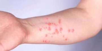 Mpox: Brasil registra 140 casos em 2026