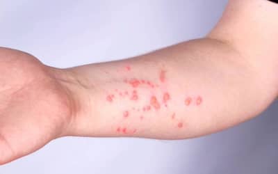 Mpox: Brasil registra 140 casos em 2026 Mpox: Brasil registra 140 casos em 2026